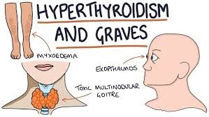 When the Thyroid Works Too Fast A Simple Guide to Graves Disease